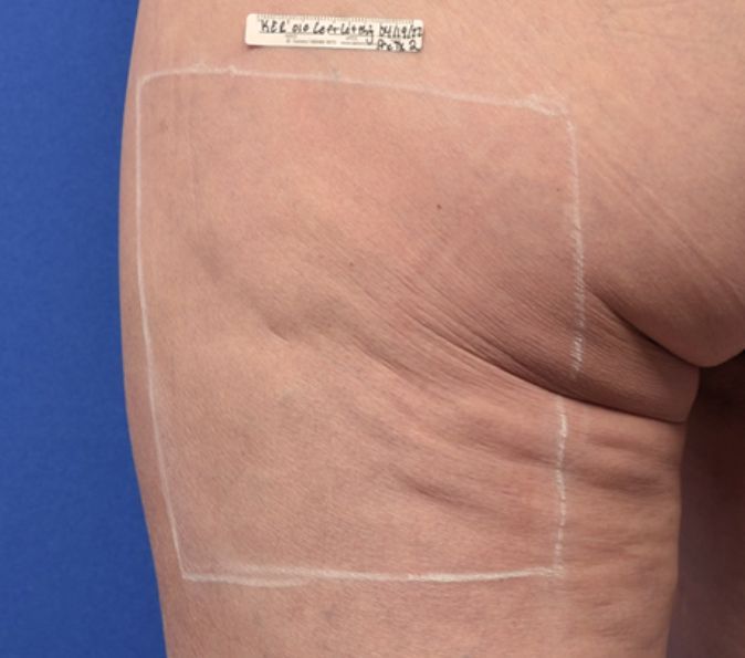 Sofwave Before & After