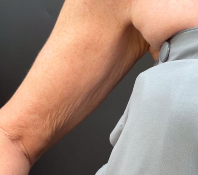 Sofwave Before & After