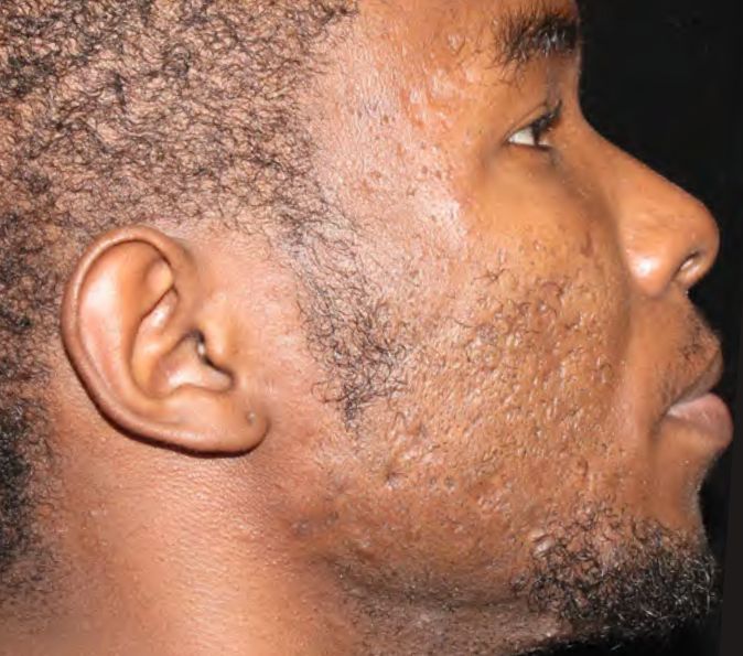 Sofwave Before & After