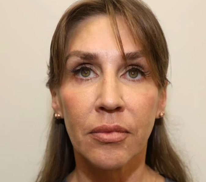 Sofwave Before & After