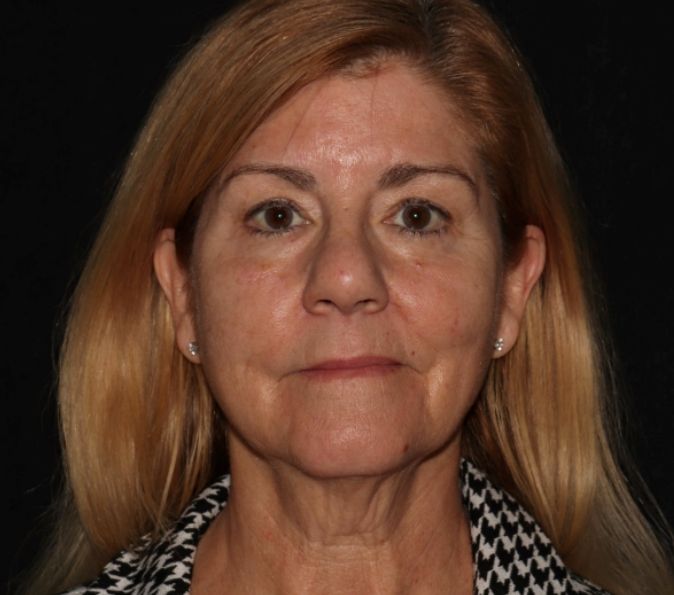 Sofwave Before & After