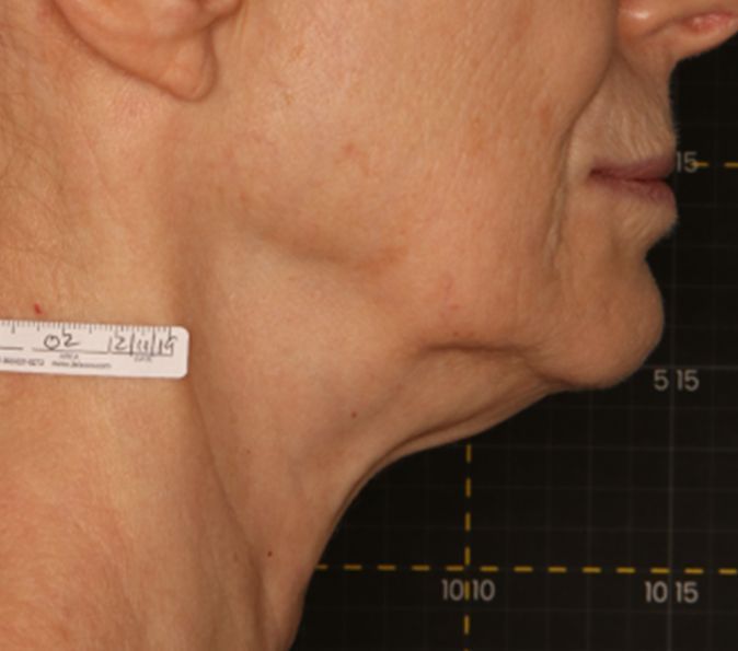 Sofwave Before & After