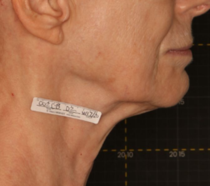 Sofwave Before & After