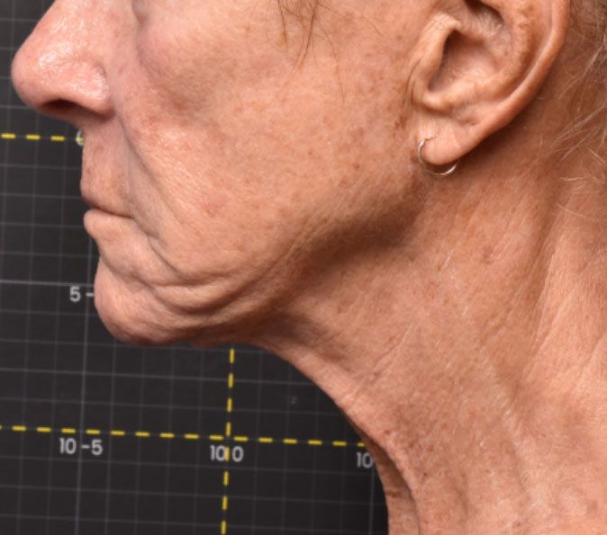 Sofwave Before & After