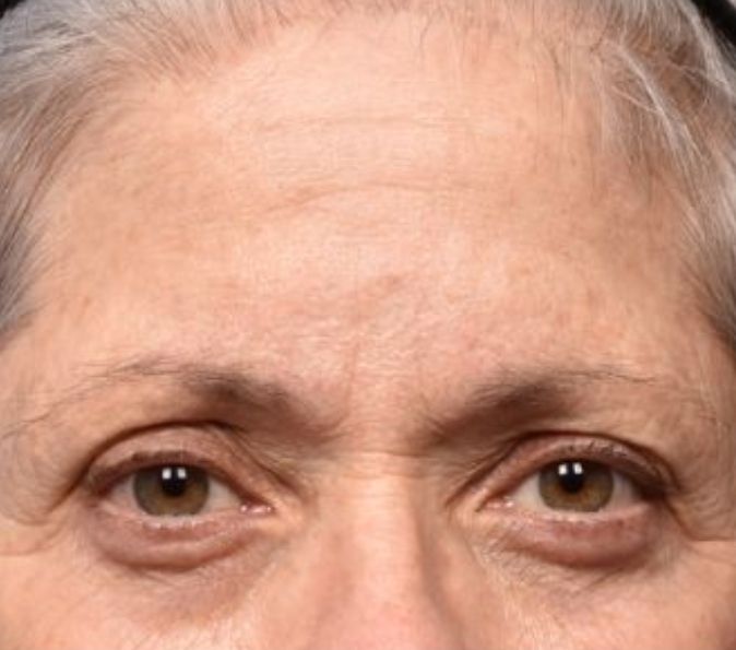 Sofwave Before & After